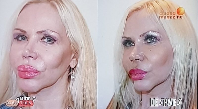 Alejandra Pradón reapareció en un programa de cirugías: se hizo la cara nueva y un rejuvenecimiento vaginal