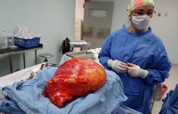 Médicos mexicanos extirparon a una paciente un tumor de 17 kilos