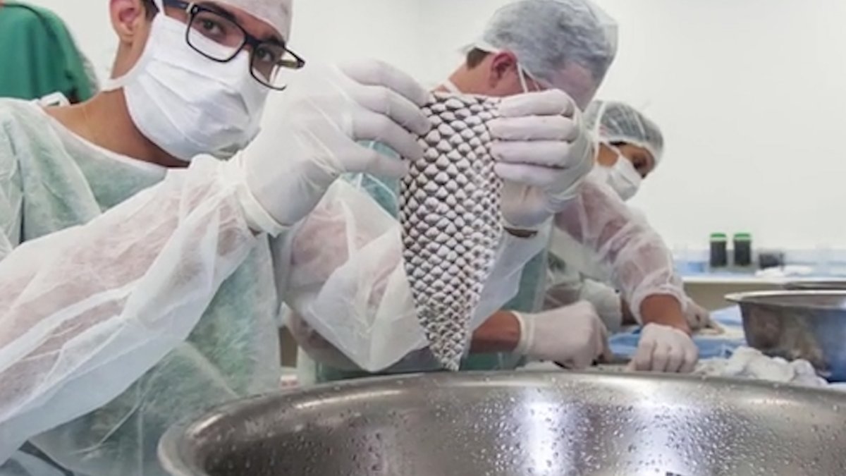 Una mujer transgénero se convirtió en la primera en recibir un implante de vagina hecho con piel de pescado