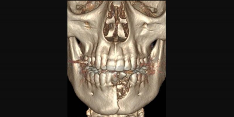 Quería dejar de fumar y usó un cigarrillo electrónico que le explotó destrozando su mandíbula