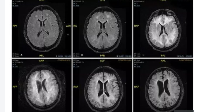 Revelan imágenes de cómo la cocaína “come” el cerebro de un adicto