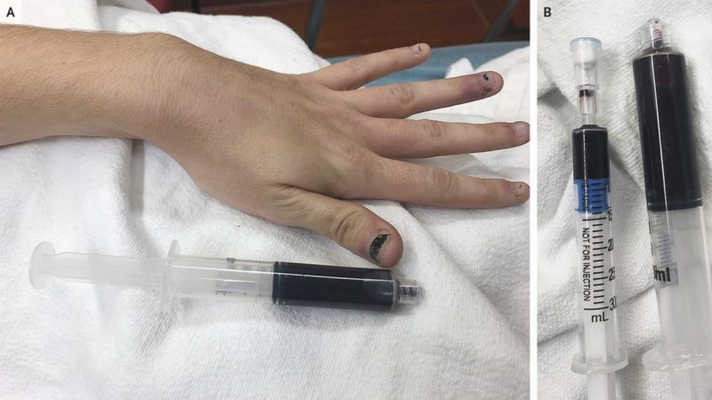 Una mujer fue al hospital y descubrió que su sangre se había vuelto azul