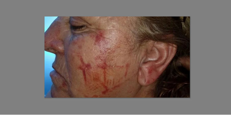 Brutal ataque motochorro: asaltó a una mujer y le dejó la zapatilla marcada en la cara