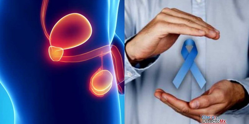 Descubren una relación directa entre la alimentación y el cáncer de próstata