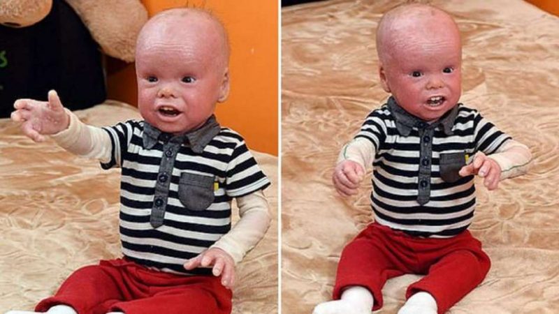 La rara enfermedad que sufre un bebé al que confunden con un muñeco de juguete