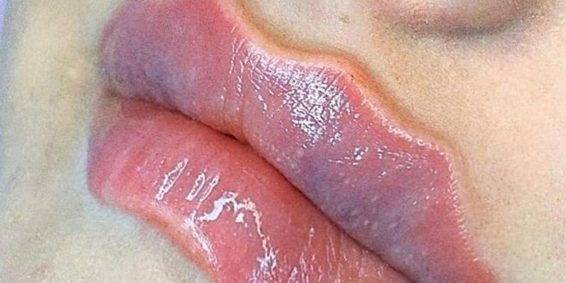 Advierten por una peligrosa moda viral: los “labios del diablo”