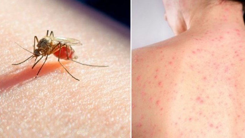Confirman la muerte de una mujer por sarampión y la de un hombre por dengue