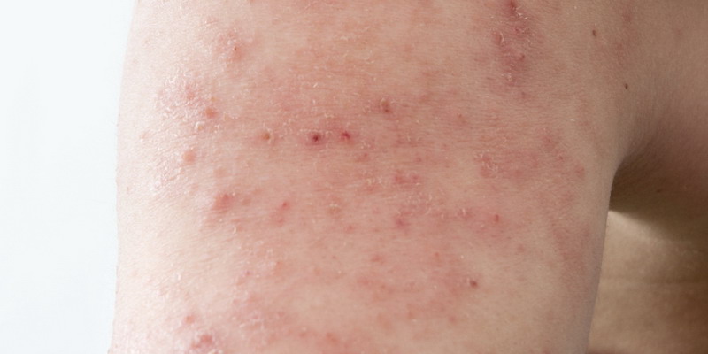 Dermatitis atópica: una enfermedad que provoca picazón,