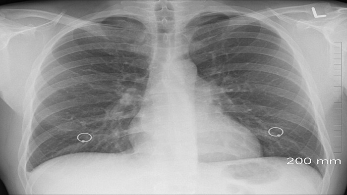 Le diagnosticaron tuberculosis y meses después confesó que el problema era que se había tragado un preservativo