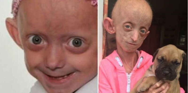 Murió a los 18 años por la enfermedad de Benjamin Button: le dejó el cuerpo de una mujer de 144