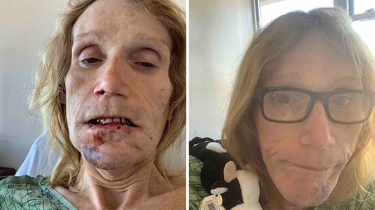 Una mujer trans demanda a las autoridades de California por meterla en una celda con hombres, uno de los cuales le rompió la mandíbula