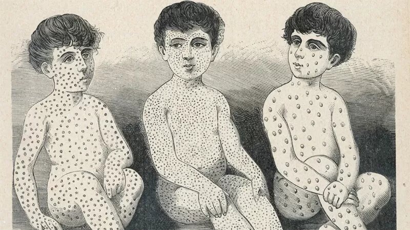 La carrera por entender la misteriosa “amnesia inmunológica” causada por el sarampión