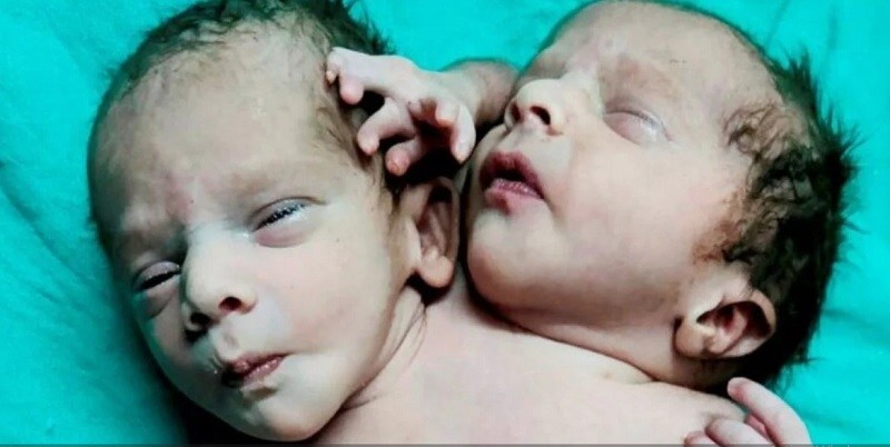 El bebé que espera el milagro: nació con dos cabezas, tres manos y dos corazones