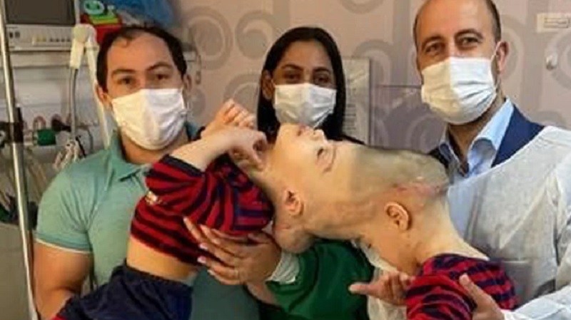 Exitosa cirugía que separó a siameses en Brasil será ofrecida gratis a otros niños de América Latina