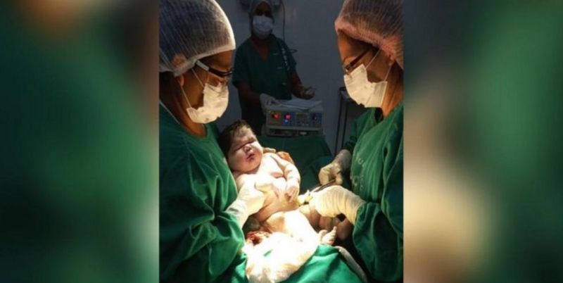 Nace un “bebé gigante” de 7,3 kg en Brasil: cuáles son las causas y los riesgos de la macrosomía