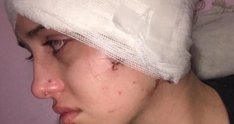 El duro relato de la moza agredida por dos hombres en Mendoza: “Me arruinaron la cara, tengo el oído sordo”
