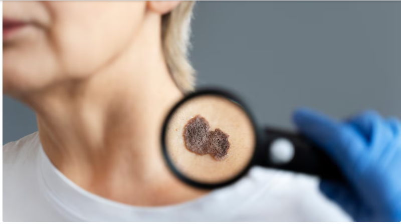 5 señales para detectar un lunar peligroso y prevenir el cáncer de piel